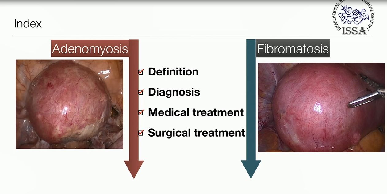 Fibromatosi e adenomiosi: strategie diagnostiche e terapeutiche